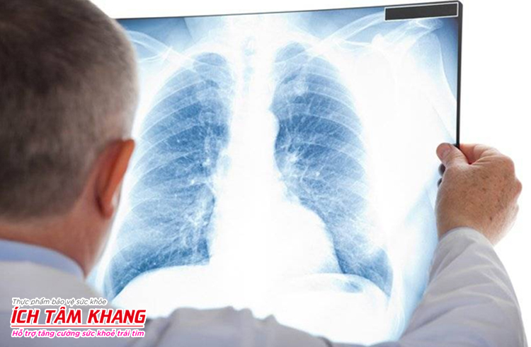 Chụp X quang lồng ngực là một cách chẩn đoán bệnh tim to